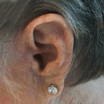 Mohs Ear Patient 11 Thumbnail After - 2