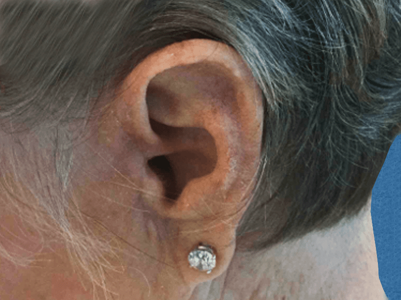 Mohs Ear Patient 11 After - 2