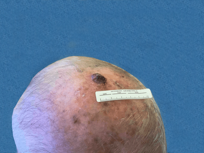 Mohs Scalp Patient 01 Before