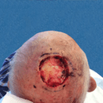 Mohs Scalp Patient 01 Thumbnail After