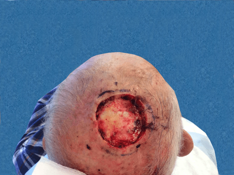 Mohs Scalp Patient 01 After