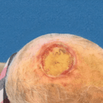 Mohs Scalp Patient 01 Thumbnail Before - 2