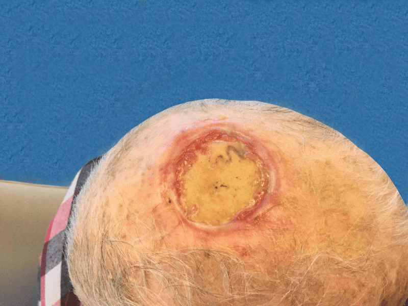 Mohs Scalp Patient 01 Before - 2