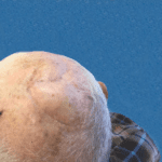 Mohs Scalp Patient 01 Thumbnail After - 2