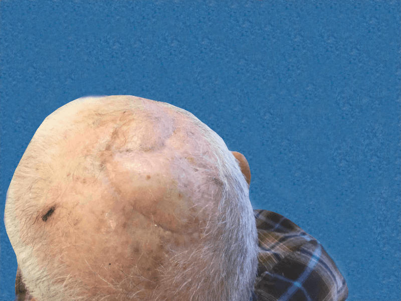 Mohs Scalp Patient 01 After - 2