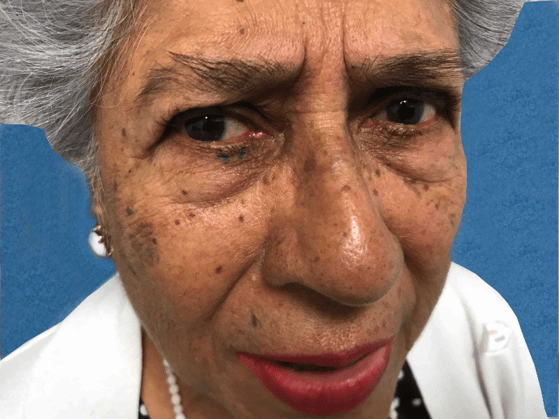 Mohs Eye Patient 06 Before