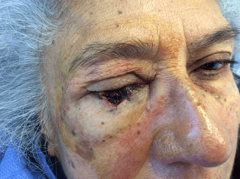 Mohs Eye Patient 06 After