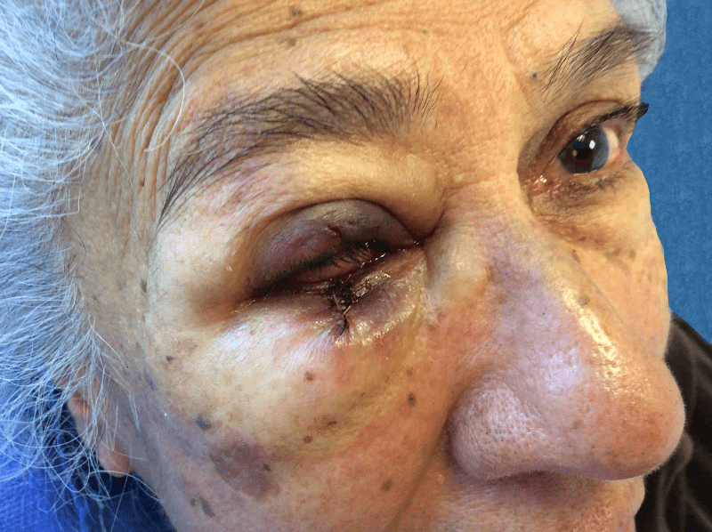 Mohs Eye Patient 06 Before - 2