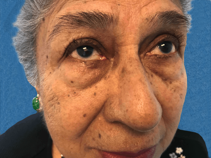 Mohs Eye Patient 06 After - 2