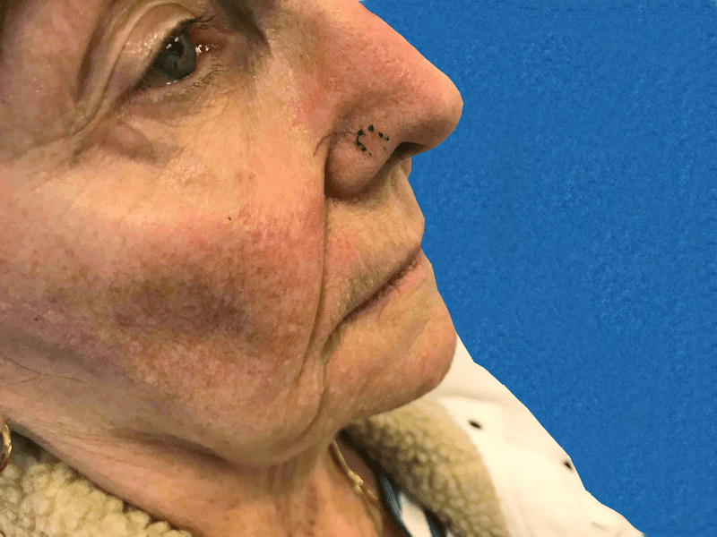 Mohs Nose Patient 23 Before