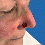 Mohs Nose Patient 23 Thumbnail After