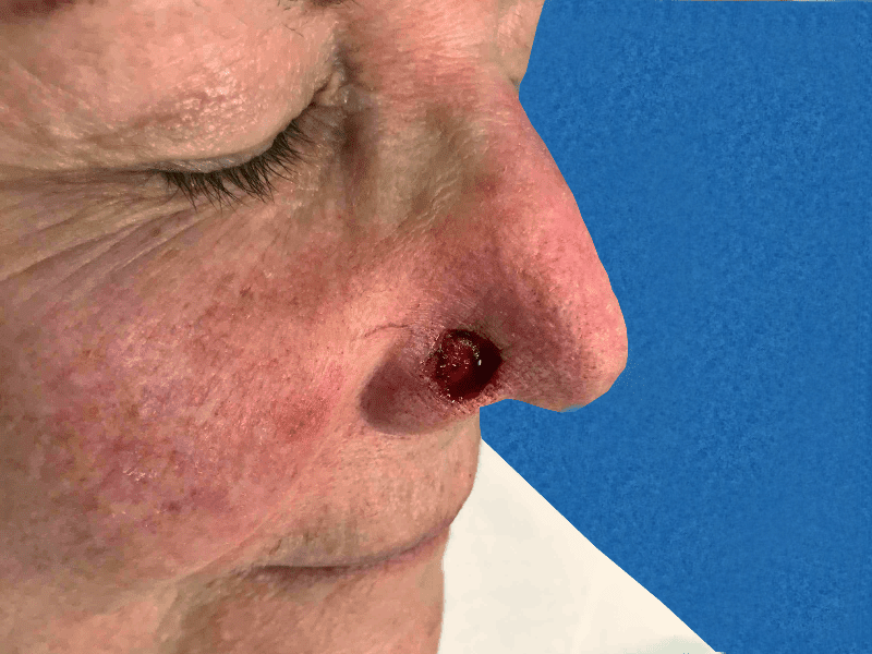 Mohs Nose Patient 23 After