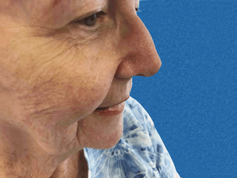 Mohs Nose Patient 23 After - 2