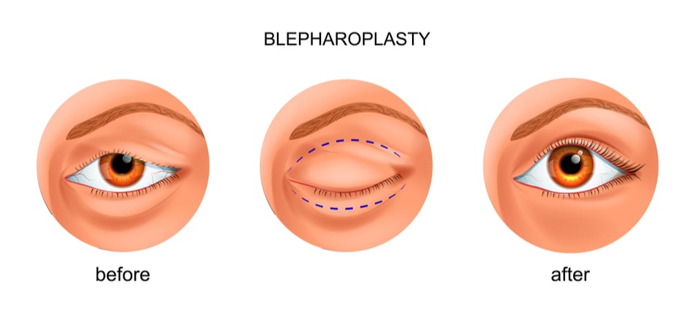 Blepharoplasty infographic of before and after procedure-img-blog