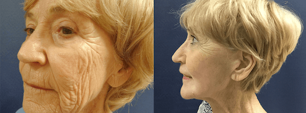 Before and after image showing the results of a Croton Oil Peel.