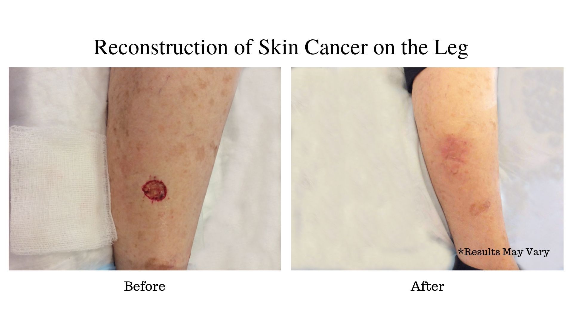 Before and after for a woman undergoing reconstruction of skin cancer on her leg in Pasadena, CA.