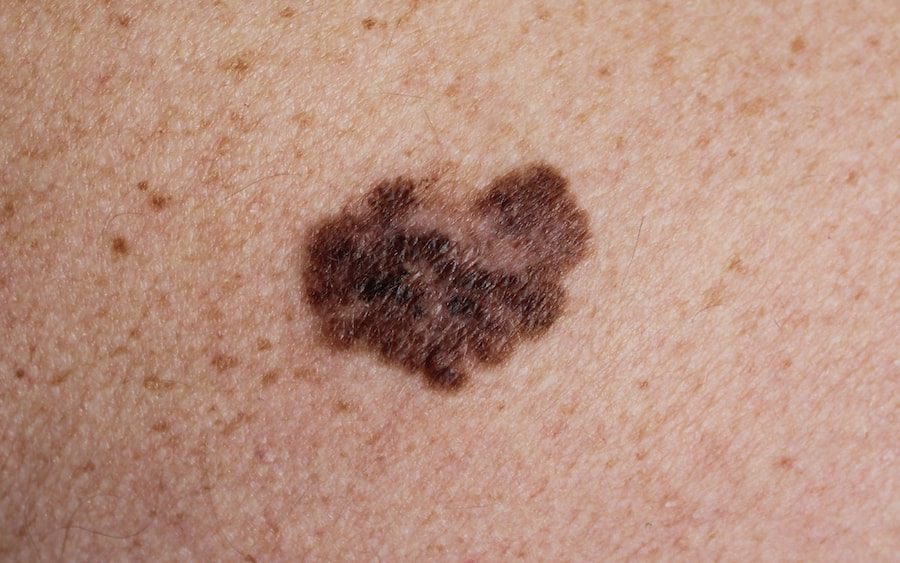  Cancerous moles tend to be irregular in shape and have different colors.
