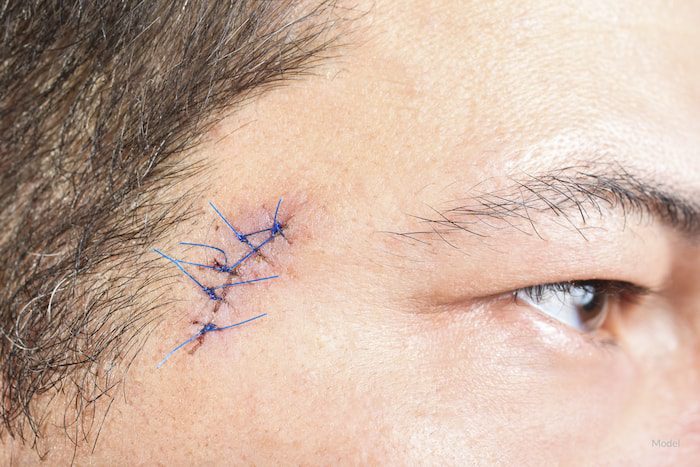 Mohs surgery scarring, Man with a healing incision after a skin cancer biopsy.