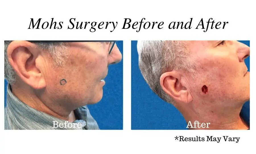 Before and after image showing the results of Mohs Surgery before the reconstruction process in Pasadena, CA.