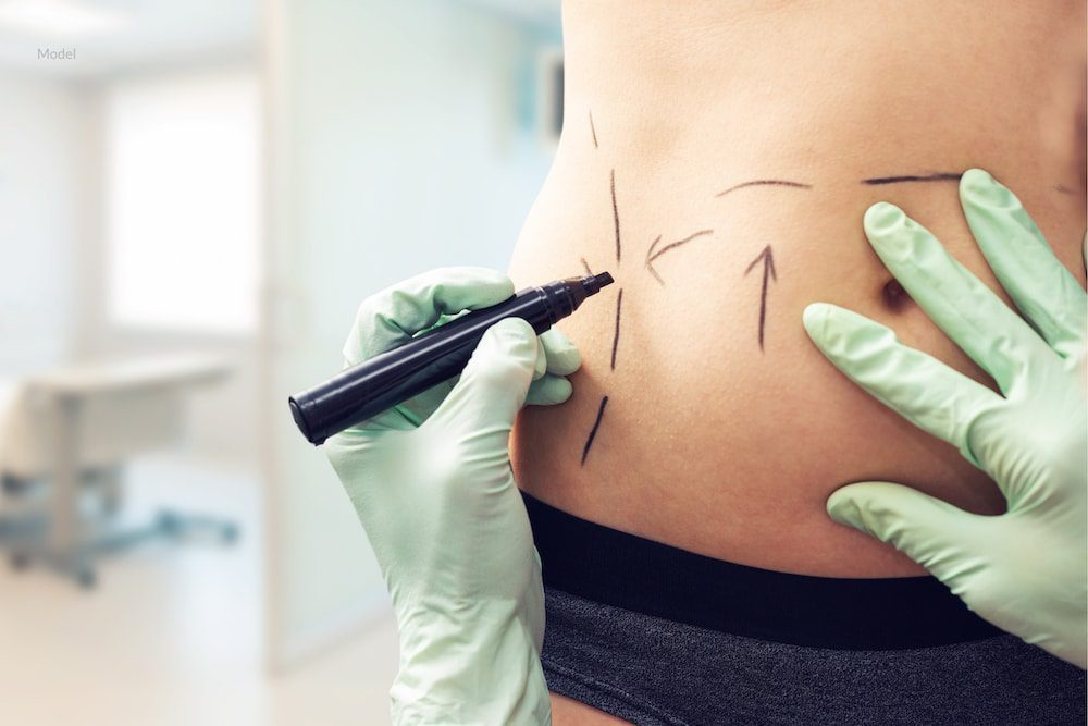 Body contouring like liposuction can smooth your physique after weight loss or pregnancy.