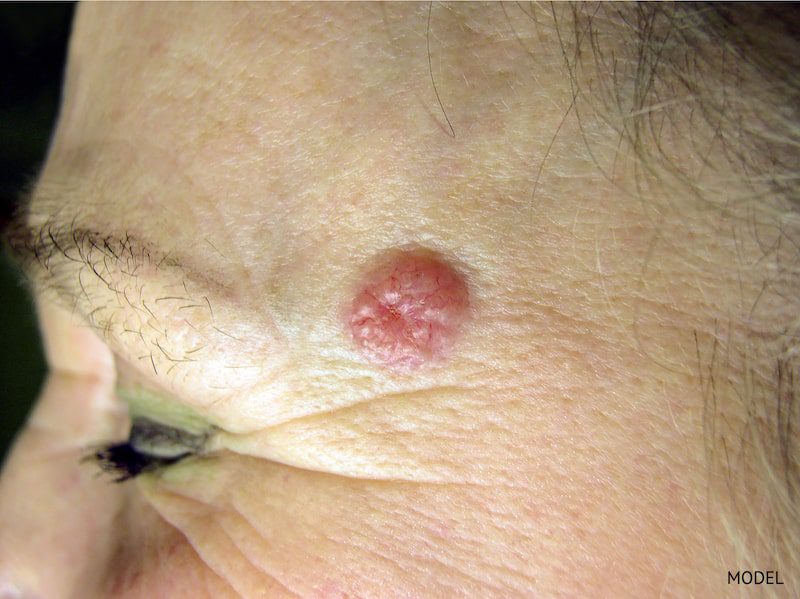 Example of a basal cell carcinoma on the face of a women near her eyebrow.