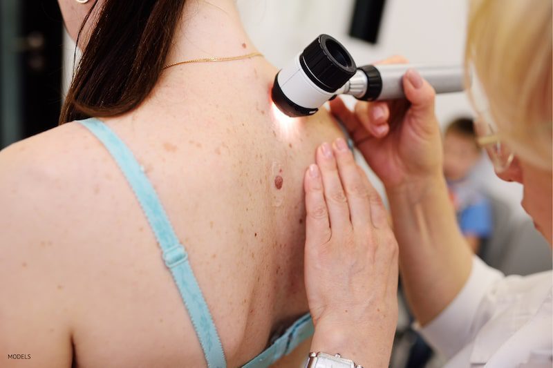 Women getting a mole on her back checked by a doctor, potentially for skin cancer