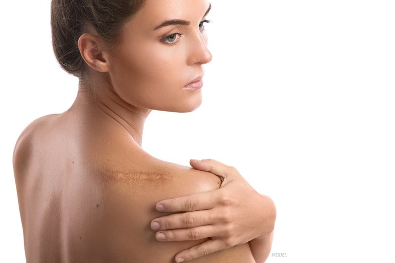 Woman exposing a scar on her bare shoulder