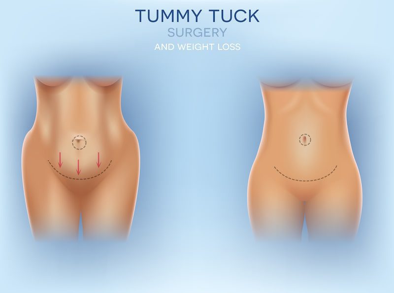 Illustration of before and after tummy tuck surgery.