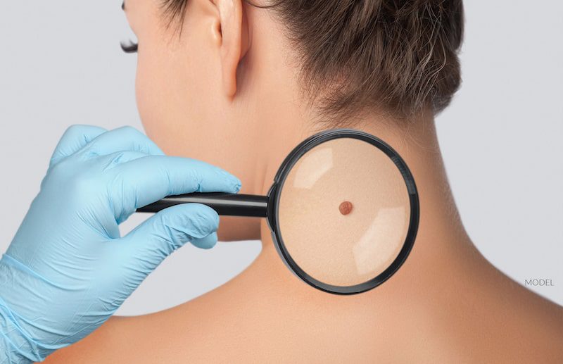 Woman's mole being checked under a magnifying glass.