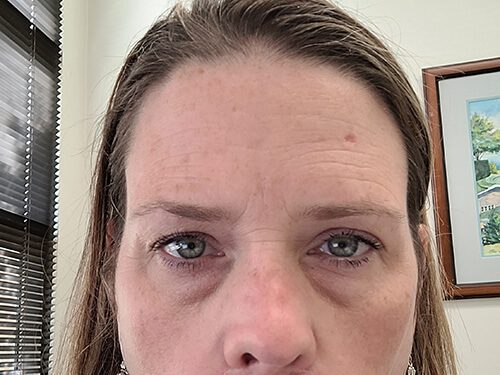 Mohs Face Patient 18 Before