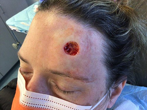 Mohs Face Patient 18 After