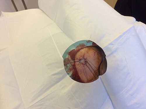 Mohs Face Patient 18 Before - 2