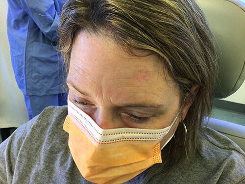 Mohs Face Patient 18 After - 2