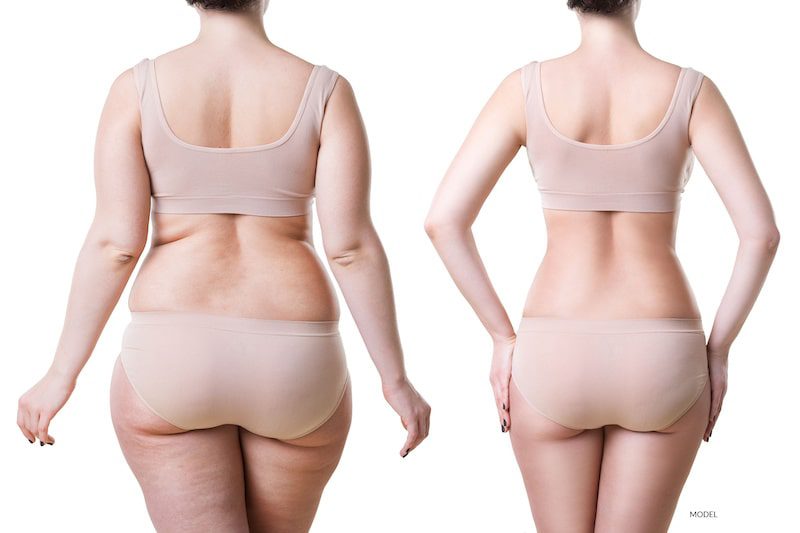 Before and after weight loss and liposuction.