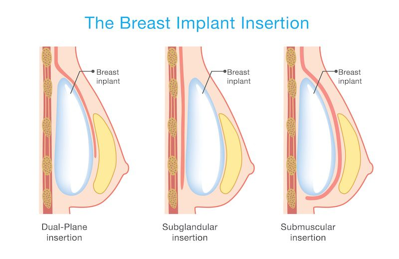 Illustration of breast implant placement options.