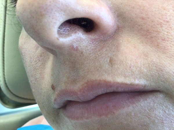 Mohs Face Patient 19 After