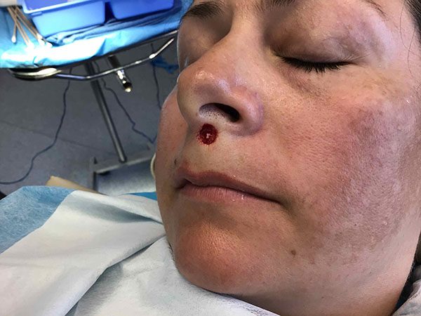 Mohs Face Patient 19 Before