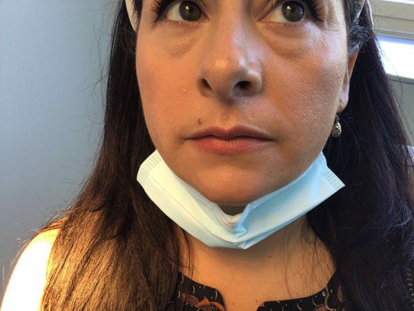 Mohs Face Patient 19 After - 2