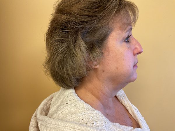 Mohs Nose Patient 25 After