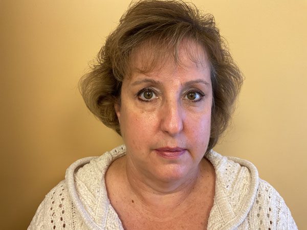 Mohs Nose Patient 25 After - 3