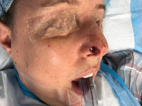 Mohs Nose Patient 25 Before