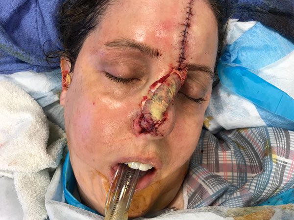 Mohs Nose Patient 25 Before - 2