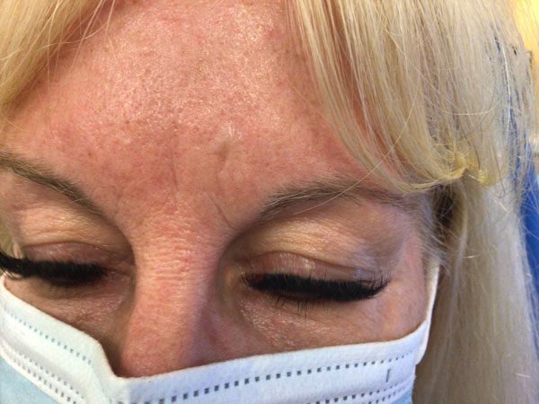 Mohs Face Patient 20 After