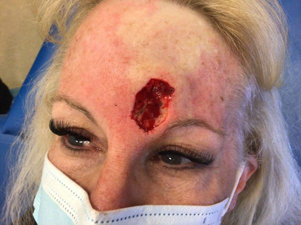 Mohs Face Patient 20 Before - 2