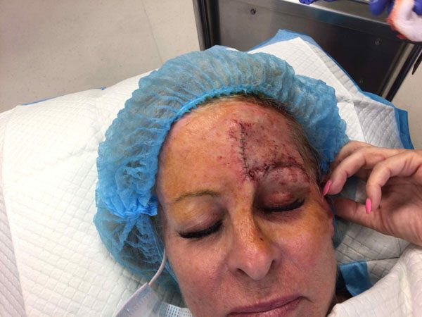 Mohs Face Patient 20 Before