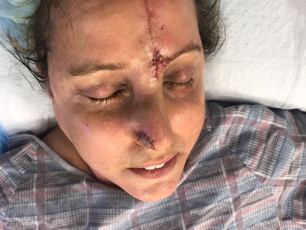 Mohs Nose Patient 25 Before - 3