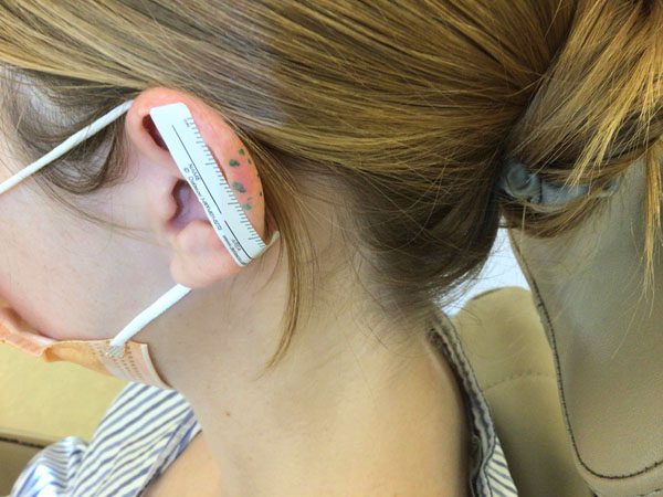 Mohs Ear Patient 12 After