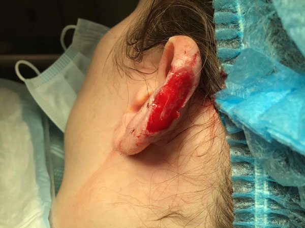 Mohs Ear Patient 12 Before