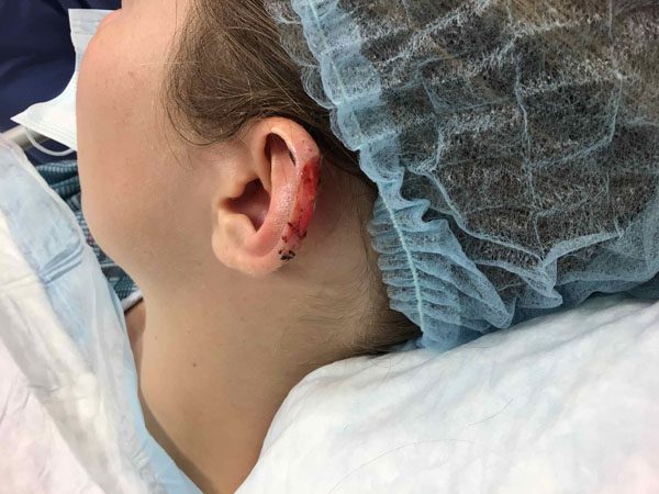 Mohs Ear Patient 12 Before - 2