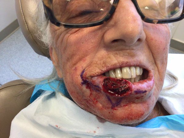 Mohs Lips Patient 09 Before